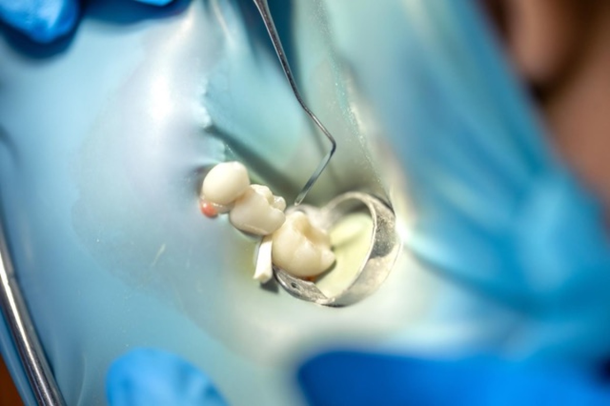 Implant czy mostek - wybór rozwiązania przy braku zęba